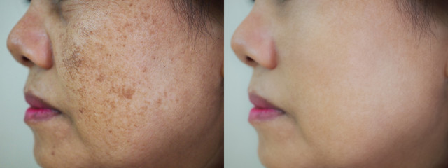 Image  before and after spot melasma pigmenttation facial treatment on face asian woman.Problem...