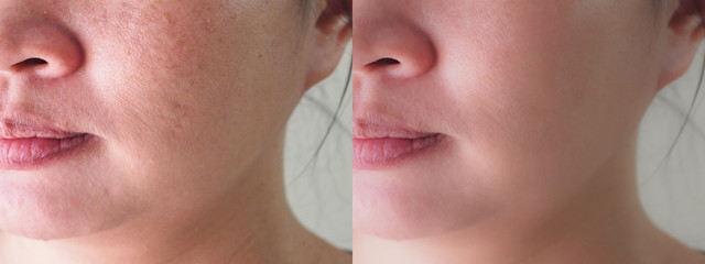 Image before and after spot melasma pigmentation skin facial treatment on face asian woman. Problem...
