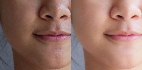 Image before and after facial treatment brightening cream on asian face young woman. Problem...