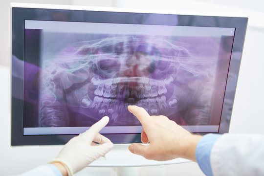 Hands of dentists point to x-ray picture