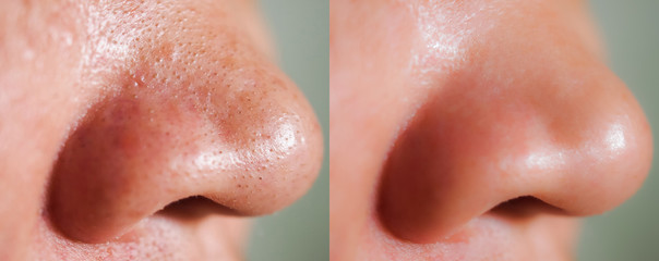 Image closeup before and after treatment small pimples acne blackheads on skin of nose and spot...