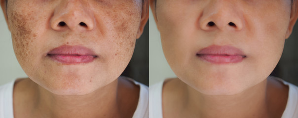 Image before and after spot melasma pigmentation facial treatment on face asian woman.Problem...