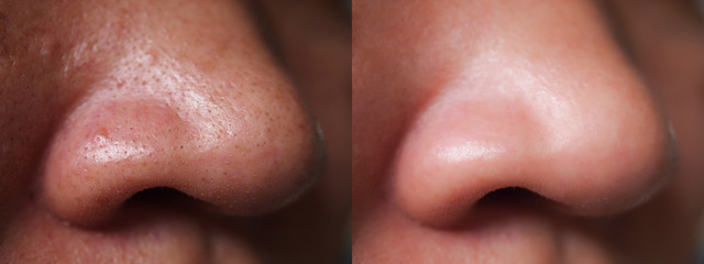 Image closeup before and after treatment small pimple acne blackheads on skin of nose and spot melasma pigmentation on facial Asian woman.Problem skincare and health concept.