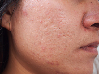 Acne pimple on face of Asian woman.Face skin Problem concept.