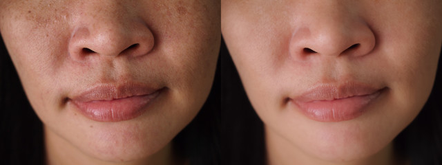 Image before and after spot melasma pigmentation facial treatment on face asian woman.Problem skincare and health concept.