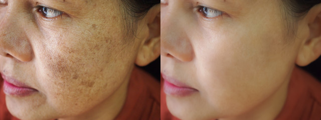 Image before and after spot melasma pigmentation facial treatment on face asian woman.Problem...