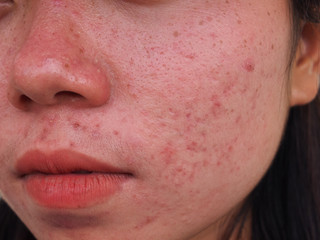 Fototapeta premium Closeup red scar acne pimple skin face texture of Asian woman.
