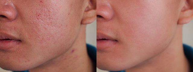 Image before and after spot red scar acne pimple treatment on face asian man.Problem skincare and...