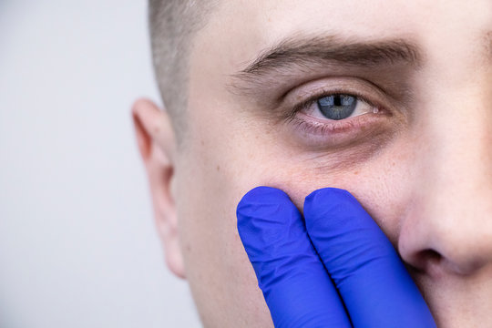 Bags under the eyes, hernias on the face of a man. Plastic surgeon examines a patient before blepharoplasty