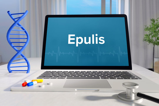 Epulis &ndash; Medizin/Gesundheit. Computer im B&uuml;ro mit Begriff auf dem Bildschirm. Arzt/Gesundheitswesen