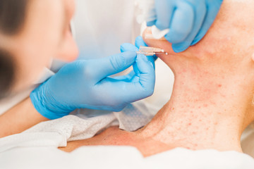 filament cosmetology - tightening of loose skin in the jaw area