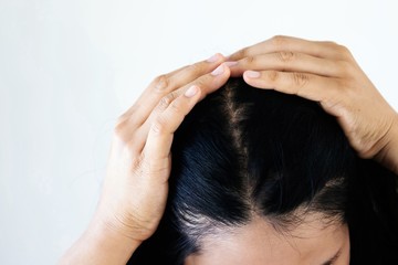 Naklejka premium Women's hair loss is caused by stress and allergic to shampoos.