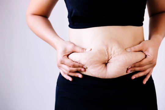 Women after birth give rise to stretch marks and belly fat.