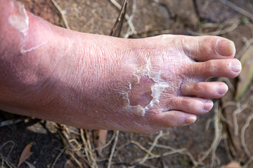 Cellulitis on leg and foot of mature diabetic man in daylight outdoors