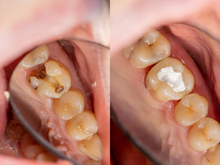 endodontic treatment of teeth close-up. Cleaning of the roots of the teeth and their filling. The...