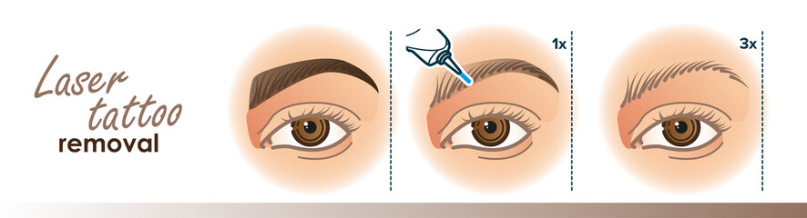 Laser permanent makeup removal stages illustration. Eyebrow tattoo removal procedure