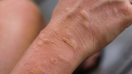 MACRO: Close up of female arm having an allergic reaction after playing with cat