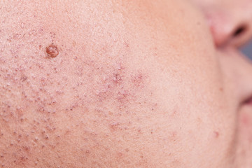 Fototapeta premium Skin face after removing hair