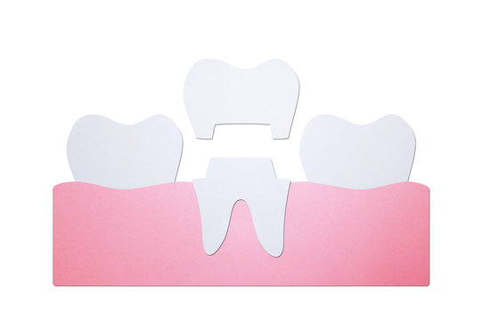 dental crown, installation process and change of teeth - tooth cartoon paper cut style