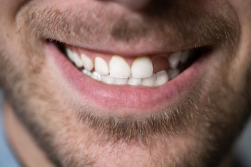 Man With Missing Tooth