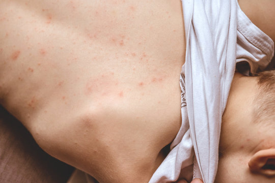 rash on the child's back. red rash in children of preschool age. rubella and chickenpox