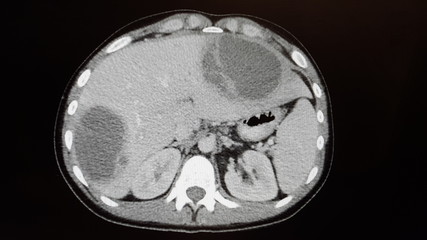 Amoebic abscesses of the liver on CT of abdomen