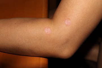Psoriasis on side of female elbow