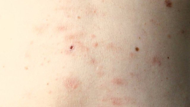 skin rash treatment on woman body. Shingles, Disease, Herpes zoster, varicella-z, lichenoid dermatitis	