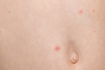 Varicella virus or Chickenpox bubble rash on boy