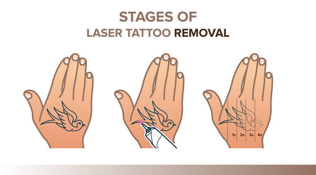 Stages of laser tattoo removal illustration