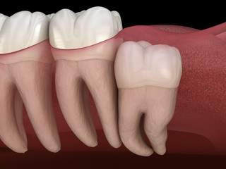 Wisdom tooth with impaction at molar tooth. Medically accurate tooth 3D illustration