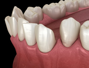 Abnormal teeth position, orthodontic concept. Medically accurate tooth 3D illustration