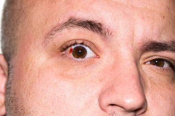 Eye injury, young man with burst blood vessel in eye, fatigue, problems with blood vessels