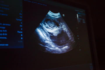 Snapshot of the dog's pregnancy on the monitor screen. Veterinarian points finger at the dog's pregnancy. Veterinary Concept. Veterinarian is doing ultrasound. View the puppy in the dog.