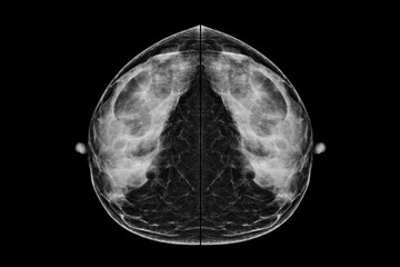 Digital Mammogram in CC view.used in diagnosis, screening of breast cancer.