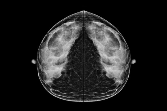 Digital Mammogram in CC view.used in diagnosis, screening of breast cancer.