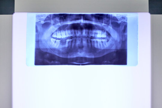Closeup x-ray of human teeth