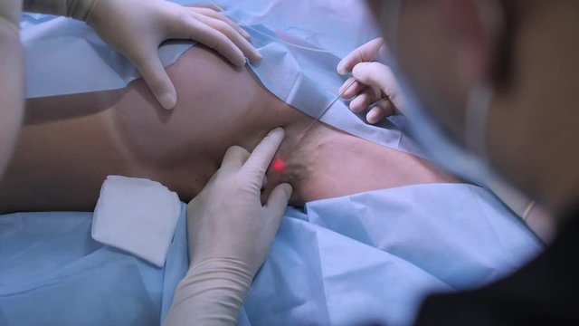 Doctor inserting a CO2 Surgical Laser under the skin of the armpit. Surgical treatments for excessive sweating (Hyperhidrosis).