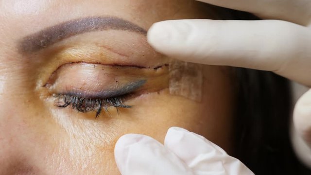 Extreme close-up of a woman's eyelids, a doctor in white gloves examines a patient's face after blepharoplasty of the eyelids