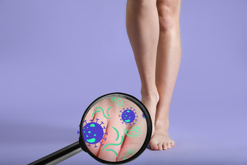 View at skin of young woman with fungal infection of feet through magnifier