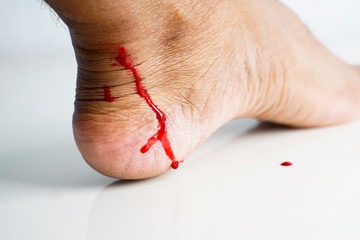 bloody feet
