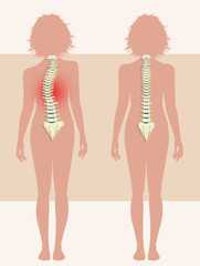 girl with scoliosis problem