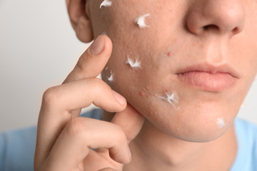 Obraz na płótnie Canvas Teen guy with acne problem applying cream on light background, closeup