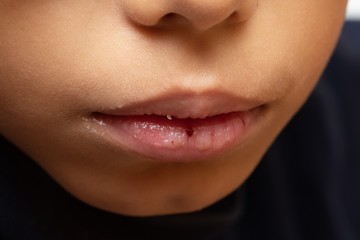 Close up of baby mouth with wound on lower lip