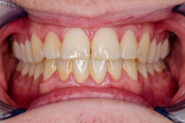 zahnstein und gingivitis