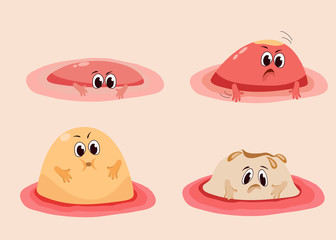 Different stages of acne.