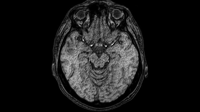 Voluminous MRI scans of the brain and head to detect tumors. Diagnostic medical tool
