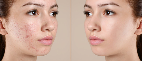 Teenage girl before and after acne treatment on beige background