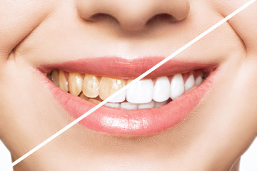 woman teeth before and after whitening. Over white background. Dental clinic patient. Image...