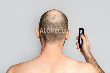 Male alopecia. A man with thinning hair is holding an electric razor. Rear view. Gray background....